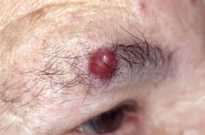 Papilloma on the eyebrows
