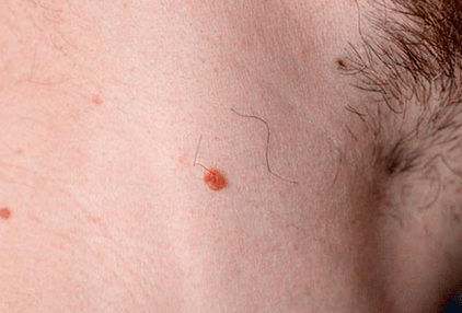 Papilloma