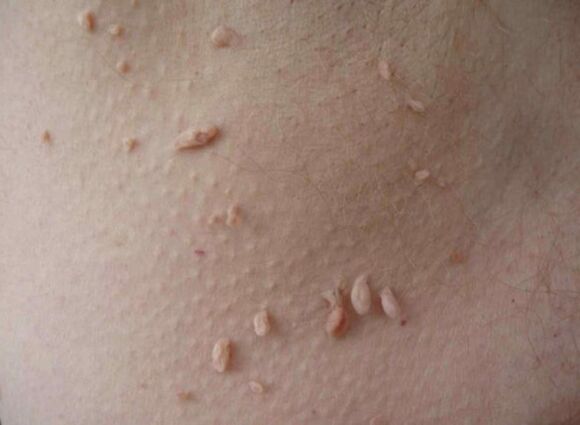 Acrochords on the skin