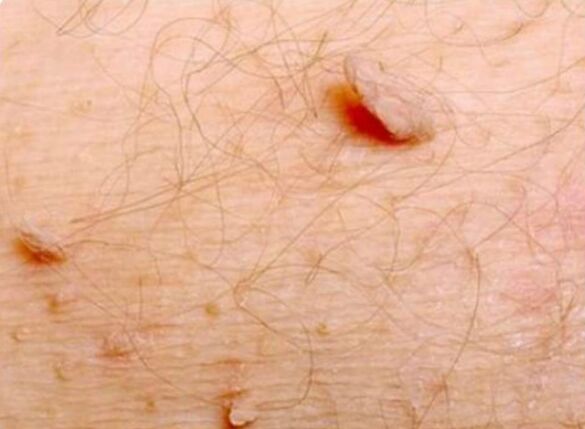Sharp papillomas on the human body