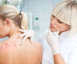 Symptoms of the human papilloma virus