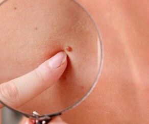 manifestations of the human papilloma virus