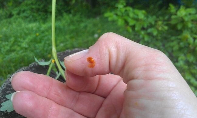 Celandine applied to finger