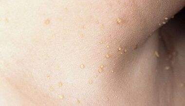 risk of developing papillomatosis on the neck