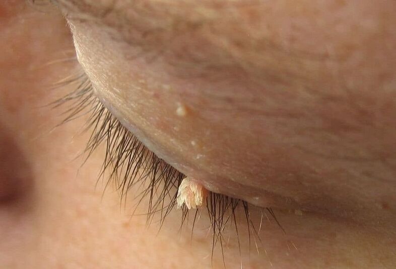 filamentous wart on the eyelid