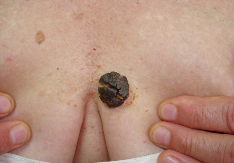 keratoma on the human body