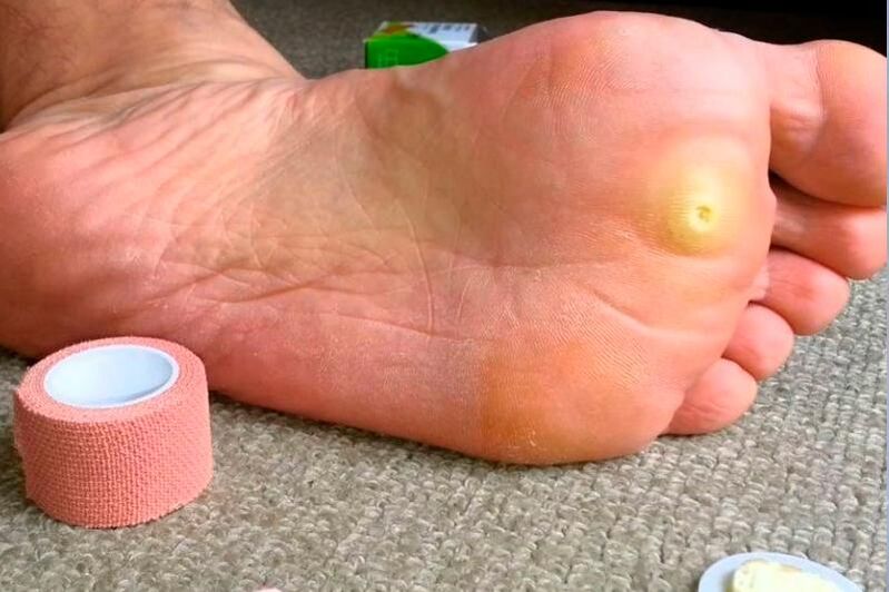 plantar wart on the foot