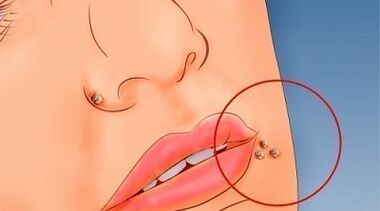 The reasons for the appearance of warts